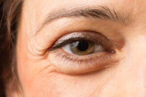 eyelid surgery in philadalphia